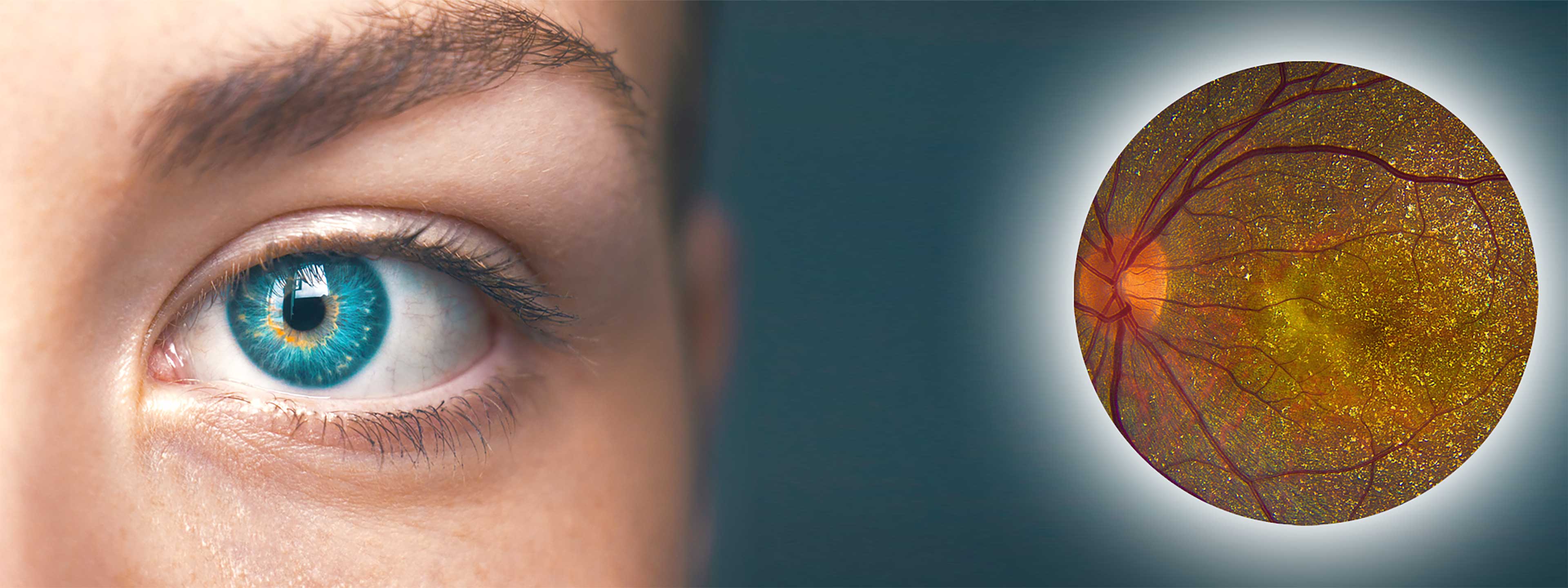 BCD is an often-misdiagnosed retinal disease.